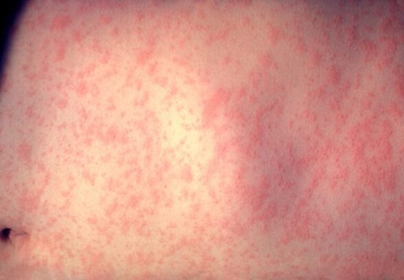 Morbillivirus_measles_infection-scaled-1