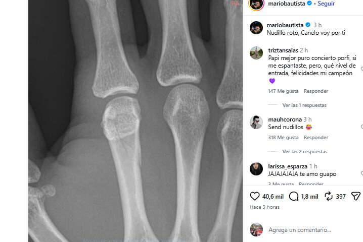 Fractura de Mario Bautista