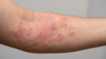 Impacto invisible de la dermatitis atópica: el ochenta por ciento de los cuidadores sufre depresión en México