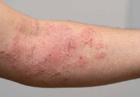 Impacto invisible de la dermatitis atópica: el ochenta por ciento de los cuidadores sufre depresión en México