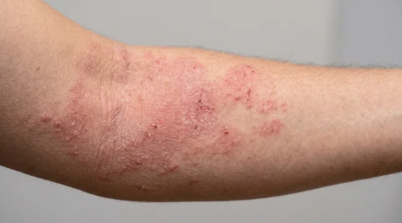 Impacto invisible de la dermatitis atópica: el ochenta por ciento de los cuidadores sufre depresión en México
